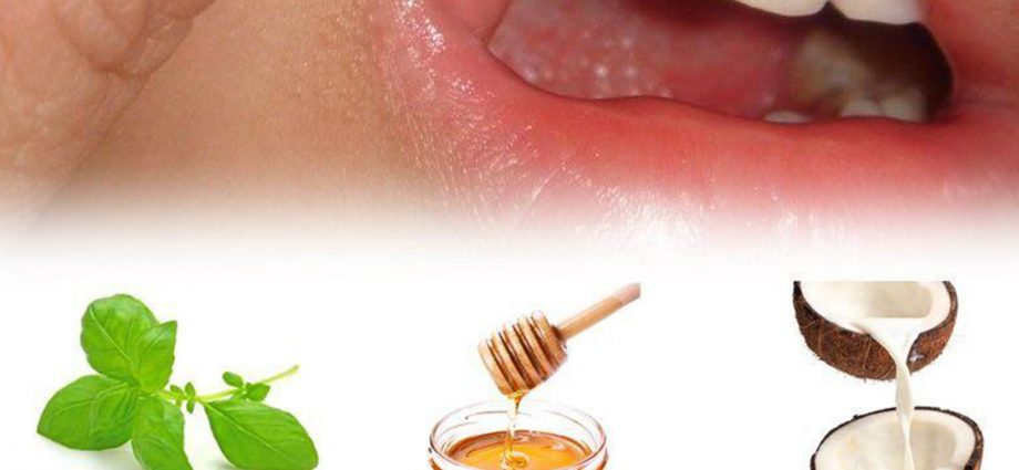 How Much Lysine Should I Take For Mouth Ulcers